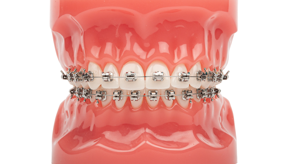 self ligating braces gunter tx