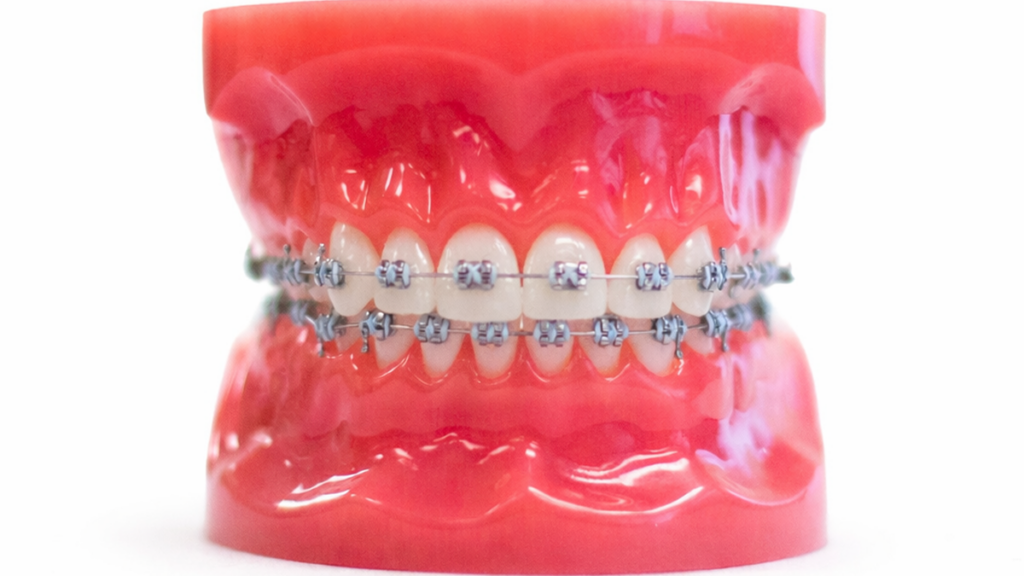 metal braces gunter tx